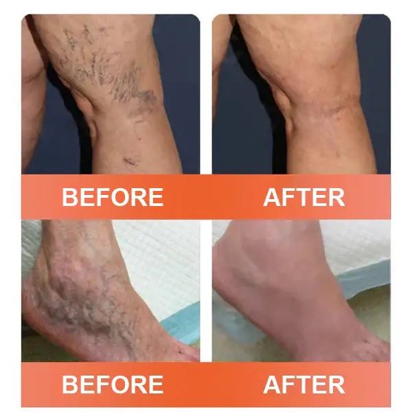 VeinEase Mikronadel-Therapie- Aufnaher - Image 6