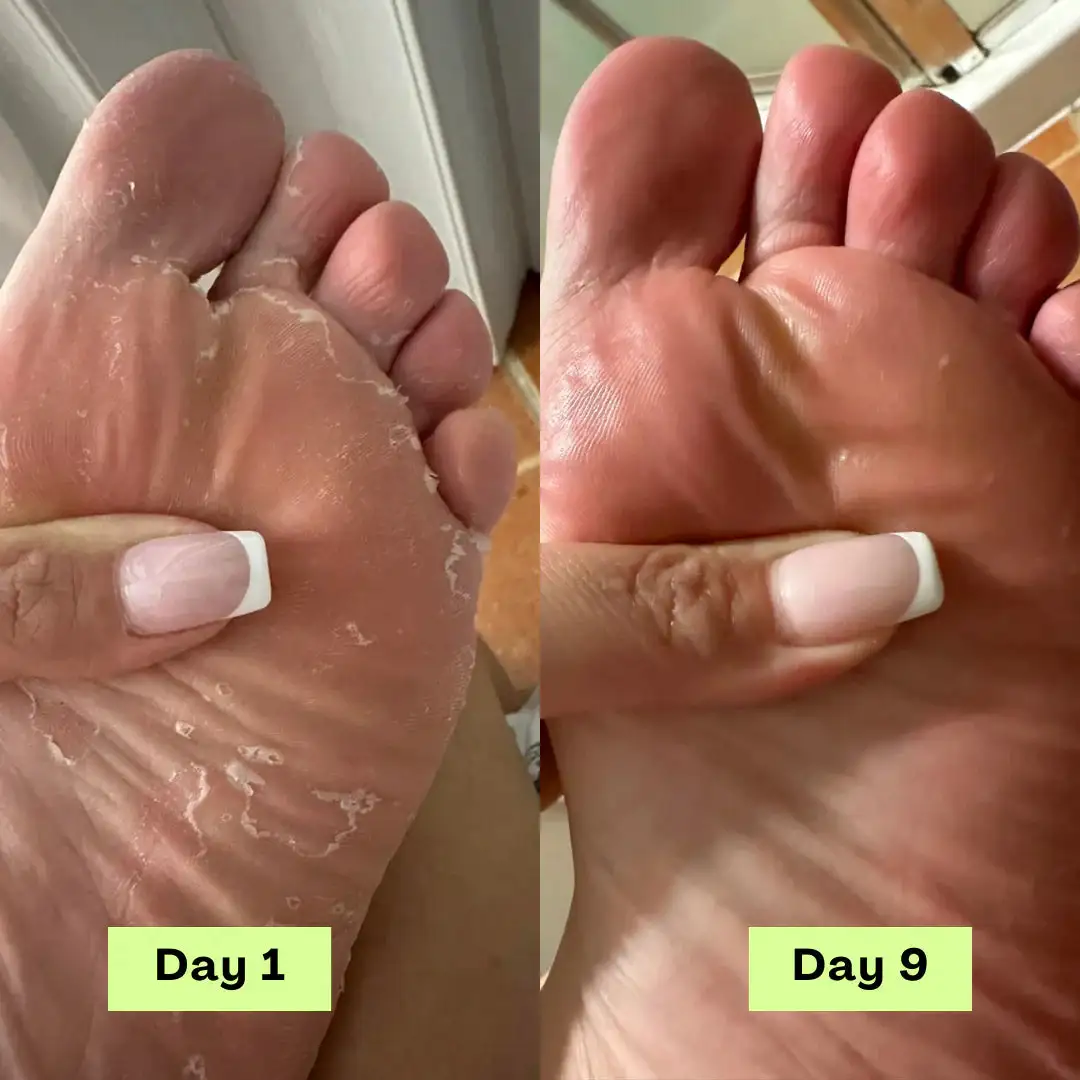 Tea Tree Athlete's Foot Defense Soap - Image 5