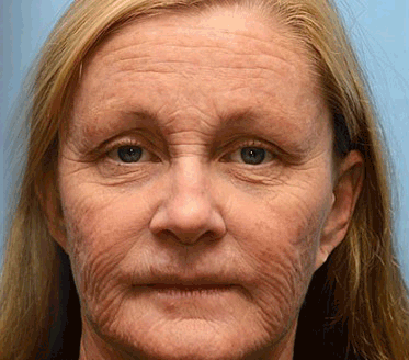 BOTOX & VITA A RETINOL SHOT Wrinkle Lift Tightening Cream - Image 11